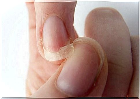 fragile nails, is it necessary to visit the dermatologist?