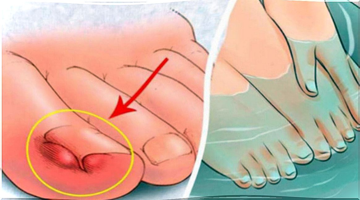 6 home remedies to relieve ingrown toenails