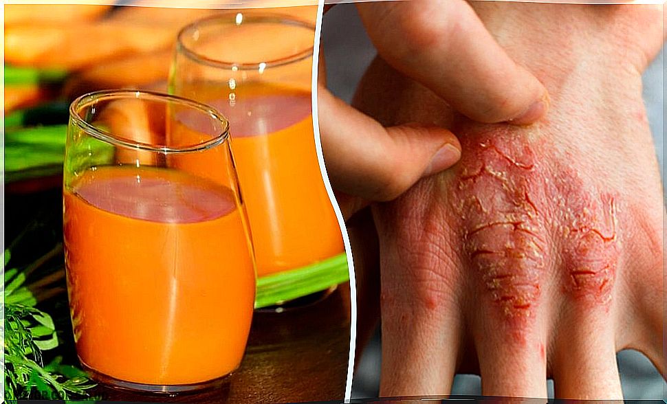 7 natural remedies to prevent and fight psoriasis