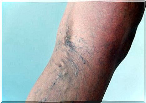 varicose veins