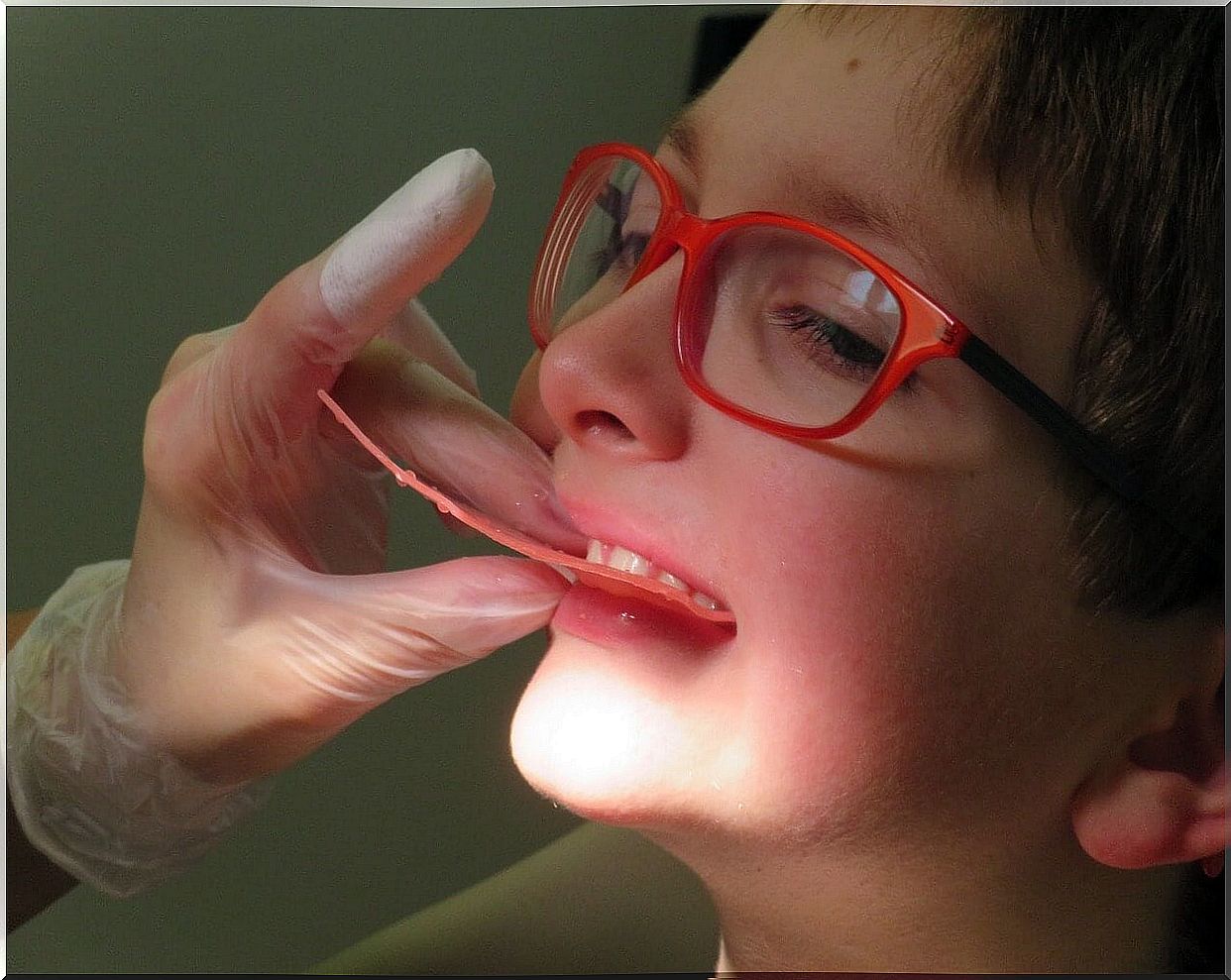 Child with a splint in his mouth.