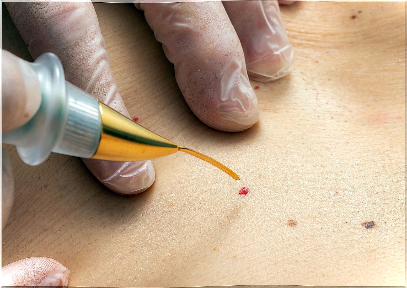 Angioma in adults