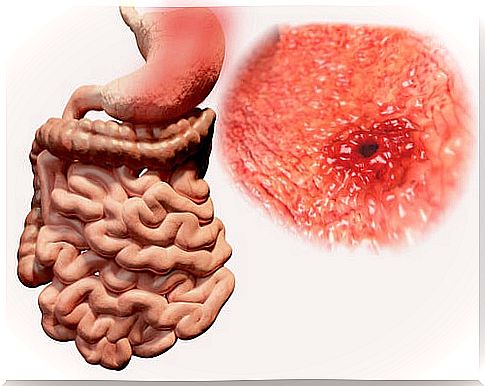 empty gastric ulcer in the stomach