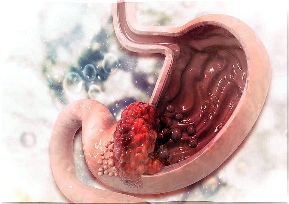 A gastric or stomach ulcer is a very bothersome injury.