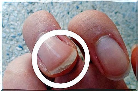 Peeling nails