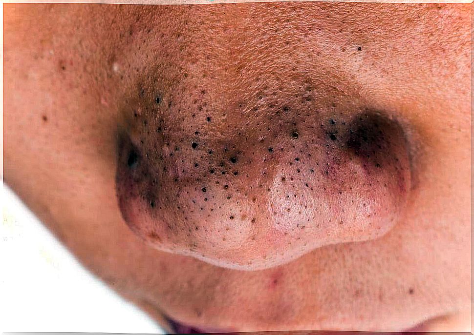 black spots on the face