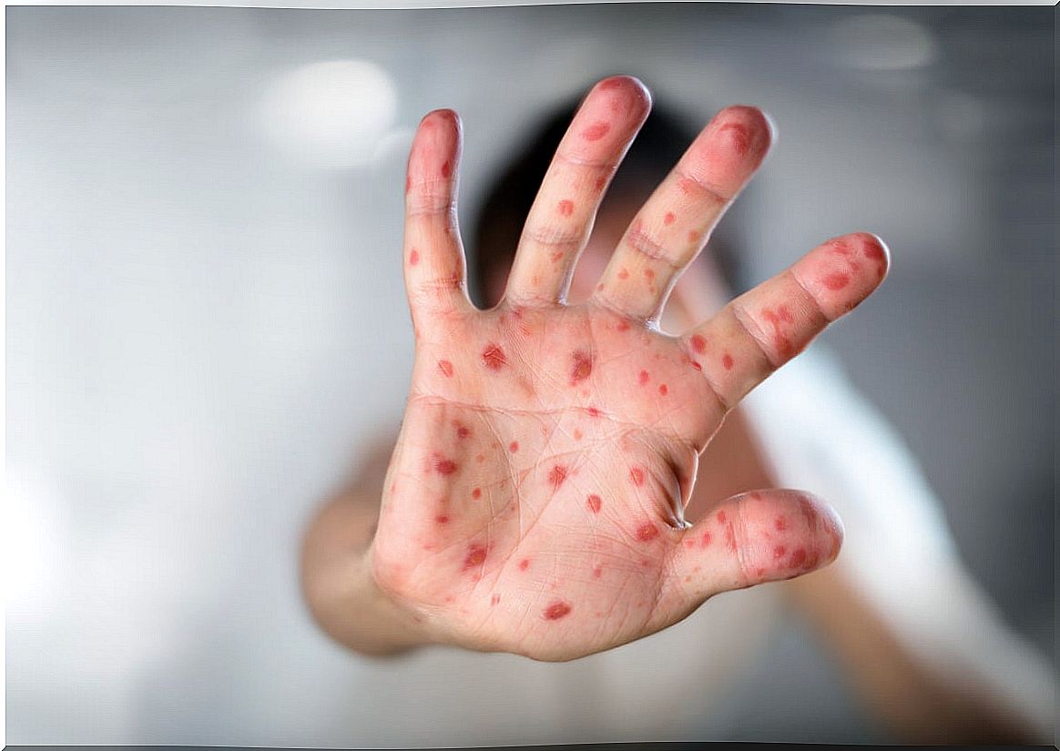 Are measles and rubella the same?