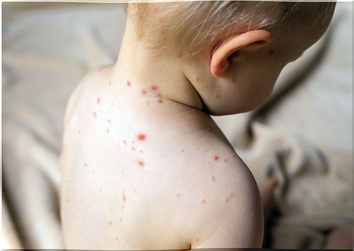 Child with measles.