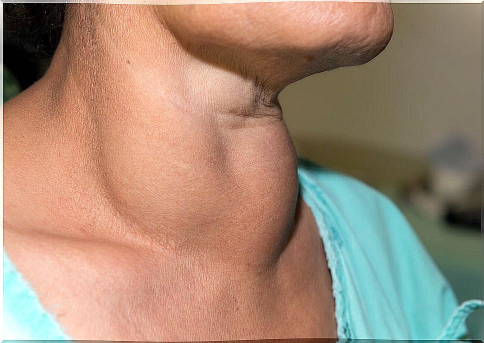 Lipoma on the neck, how to recognize it?