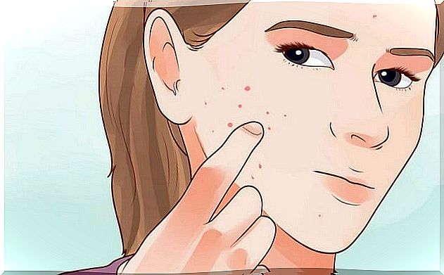 How to differentiate the different types of acne on the face