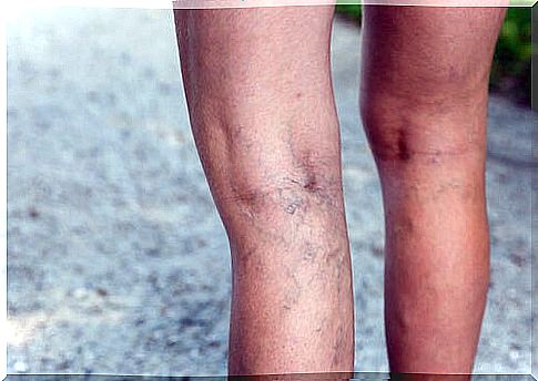 varicose veins