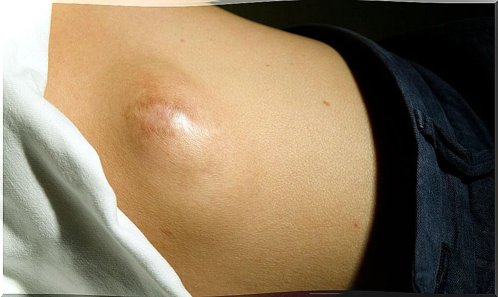 lipoma sarcoma