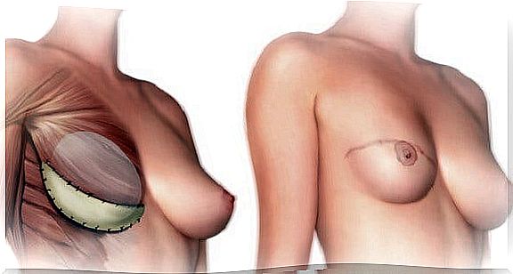 What should you know before mastectomy?