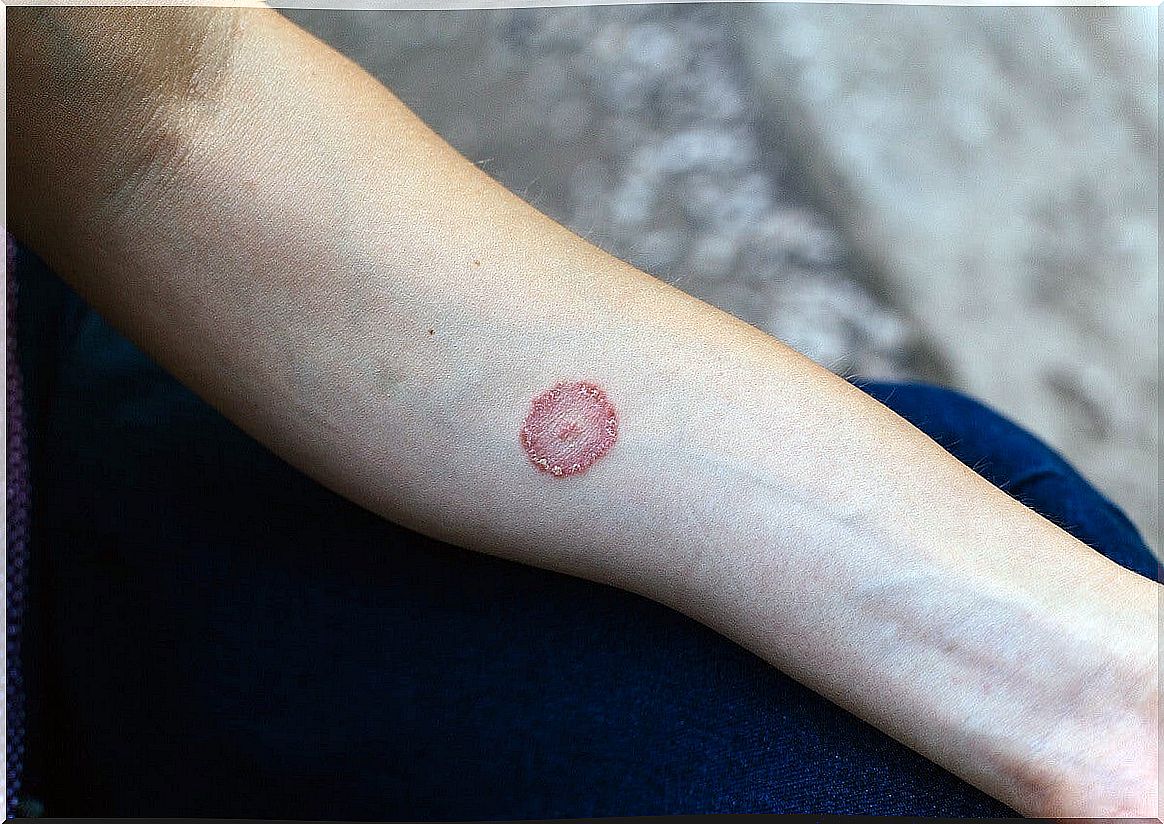 Mycosis or pityriasis versicolor