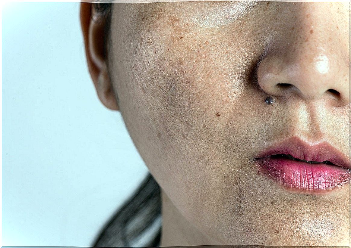 Melasma